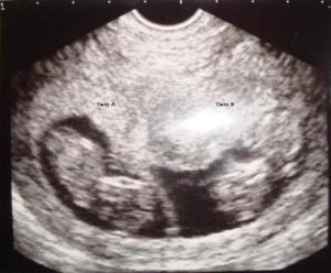 10 неделя беременности двойней