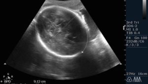 Гиперплазия плаценты при беременности 20 недель