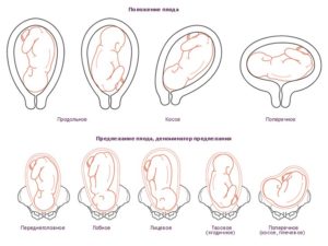 Головное предлежание плода при беременности 32 недели