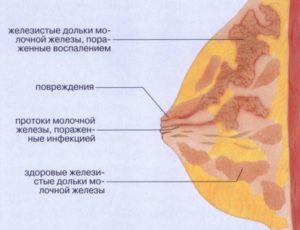 Уплотнение в молочной железе у кормящей мамы