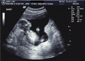 Замершая беременность на 14 неделе