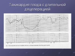 Тахикардия у плода на 36 неделе беременности