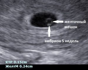 Эмбриона не видно на 5 неделе беременности