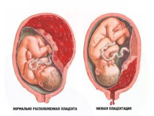 Низкая плацентация при беременности 30 недель