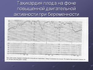 Тахикардия у плода на 36 неделе беременности