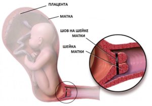 Короткая шейка матки при беременности 35 недель