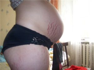 Выделения из груди на 33 неделе беременности