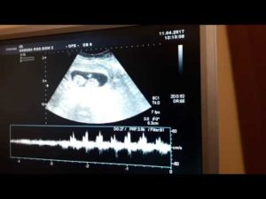 Сердцебиение на 7 неделе беременности