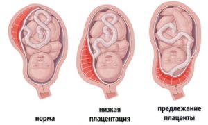 Низкое расположение плаценты при беременности 12 недель