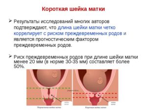 Укорочение шейки матки при беременности 30 недель