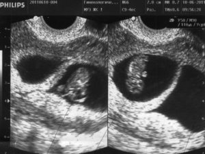 Как опорожняется гематома при беременности фото