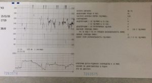 Плохое ктг при беременности 37 недель