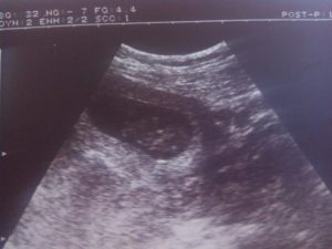 Признаки замершей беременности на 8 неделе