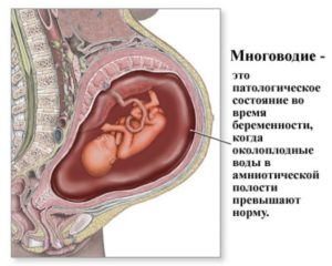 Многоводие на 30 неделе беременности