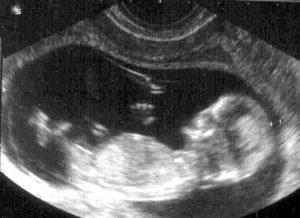 На 12 неделе беременности рвота