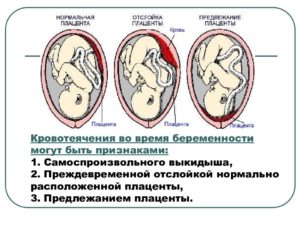 Отслойка плаценты на 12 неделе беременности