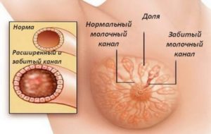 Что делать если продуло грудную железу у кормящей мамы