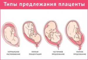 Низкая плацентация при беременности 12 недель что это значит