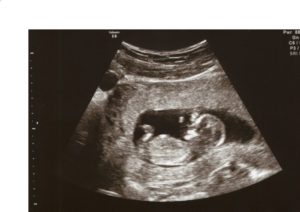 Замершая беременность на 11 неделе