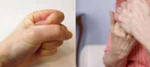 Болят суставы пальцев рук при беременности 38 недель