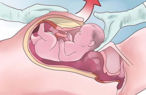 Плацента на 40 неделе беременности