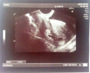 4 недели беременности не видно эмбриона