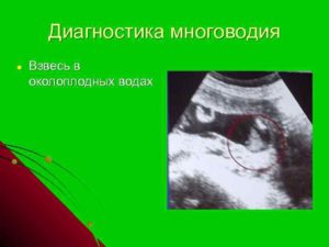 Взвесь в околоплодных водах на 22 неделе беременности