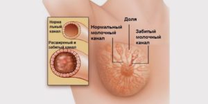 К какому врачу обращаться при лактостазе у кормящих мам