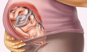 Гипоксия плода на 39 неделе беременности