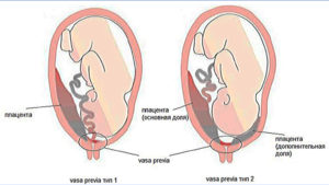 Низкое расположение плаценты при беременности 20 недель