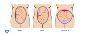 Положение плода поперечное на 37 неделе беременности