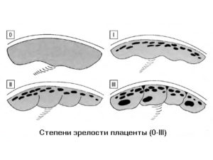 2 степень зрелости плаценты на 34 неделе беременности