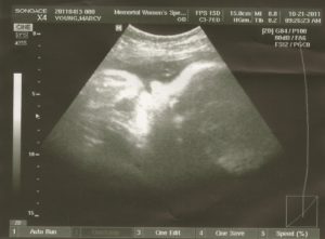 39 недель беременности у повторнородящих