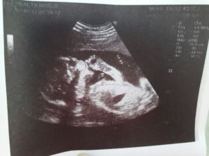 Тонус матки на 16 неделе беременности