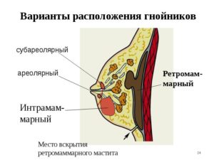 Уплотнение в молочной железе у кормящей мамы