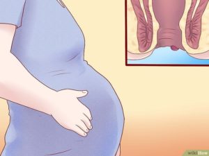 Геморрой на 32 неделе беременности