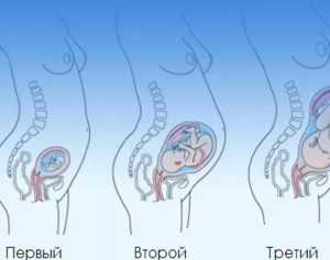 Диарея при беременности во втором триместре