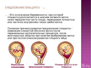 Что означает низкая плацентация при беременности в 20 недель