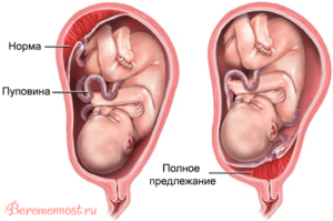 Предлежание плаценты на 20 неделе беременности