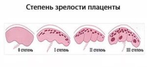 Преждевременное созревание плаценты 33 недели беременности