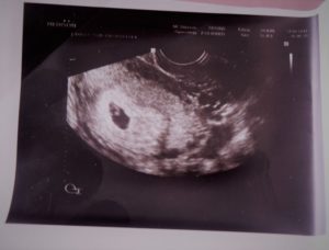 6 недель беременности не видно на узи эмбриона