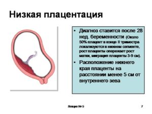 Низкая плацента при беременности 20 недель