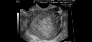 2 недели беременности видно ли на узи
