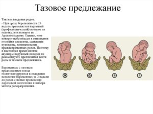 Предлежание тазовое на 20 неделе беременности