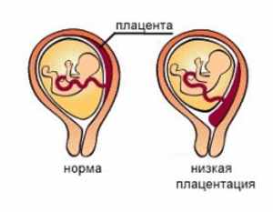 Низкая плацентация при беременности 34 недели