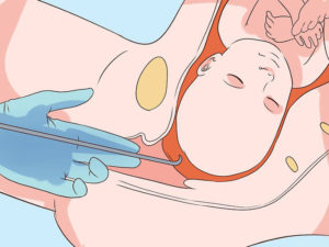 Прокол пузыря без схваток на 39 неделе беременности