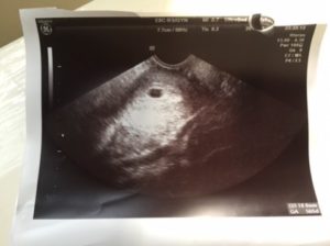 На 5 неделе беременности пошла кровь