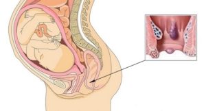 На 35 неделе беременности геморрой