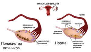 Могут ли яичники болеть при овуляции