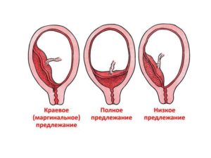 Центральное предлежание хориона на 13 неделе беременности